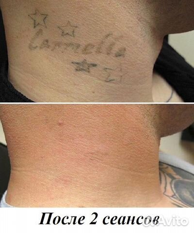 Удаление тату без шрамов Удаление тату без шрамов
