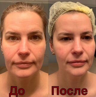 Массаж, массаж лица, RF, кавитация, лазерный липол